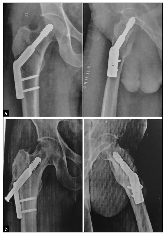 Complication. (a) Postoperative anteroposterior and lateral radiograph. (b) Radiographs at final follow-up of 1 year showing union, well-maintained alignment with backout of hip screw.